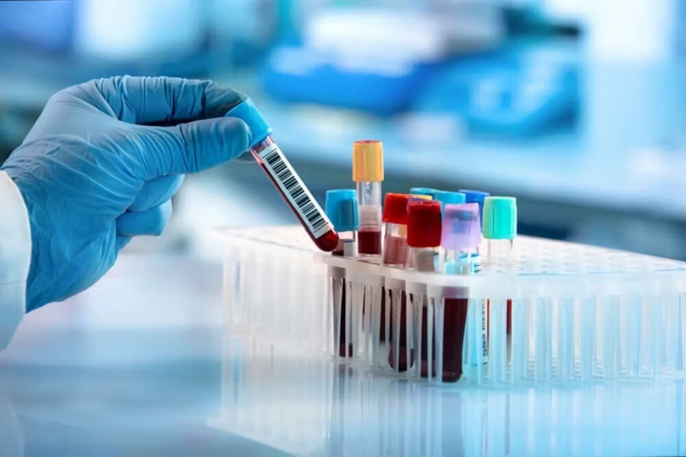 یک آزمایش خون جدید برای تشخیص پارکینسون در مراحله اولیه