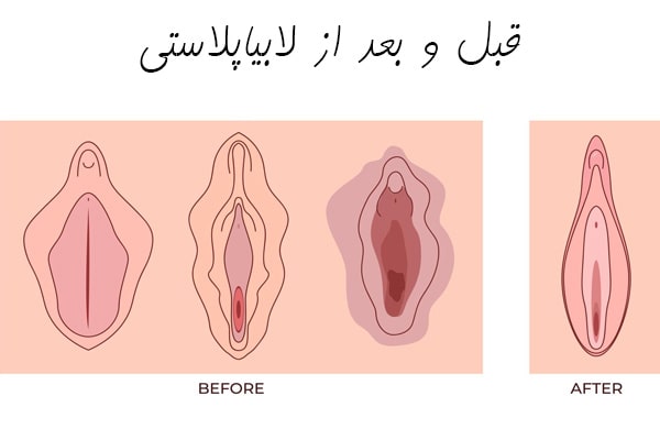 لابیاپلاستی
