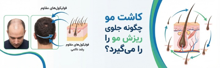 کاشت مو چگونه جلوی ریزش مو را می‌گیرد؟